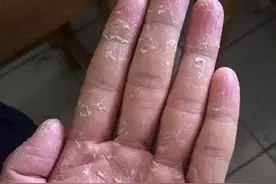 手上蜕皮，亲测有效的办法，几块钱解决问题图片
