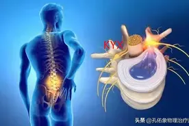 臀部疼痛、麻木，是腰突引起？6种应对方法告知您，避坑还来得及图片