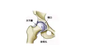 髋关节滑膜炎的治疗方法和日常保养图片