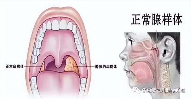 腺样体一定要切除吗？这是一个有用的器官，切前需谨慎