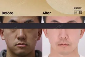 骨性地包天掩饰性正畸，让面部更和谐！图片