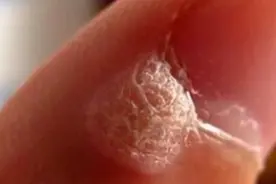做个美甲，手指竟长了“菜花”？只因忽略了这个细节......图片