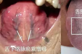 舌下青筋又粗又黑？中医：血瘀严重！4种舌象，教你正确化瘀血图片