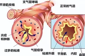 哮喘患者有痰是好事？干咳、无痰很可能预示着急性发作？图片