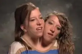 双生姐妹阿比盖尔和布列塔妮 共用一个身体结婚生子图片