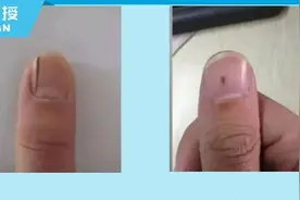 指甲黑线？别急，这几种情况无需特别治疗图片