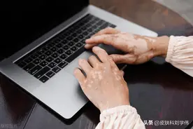 治疗白癜风的“金牌方”，一碗汤药，白斑无处可藏！图片