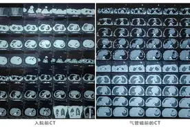 全麻下支气管镜检查及肺泡灌洗，让患儿不再望“镜”生畏图片