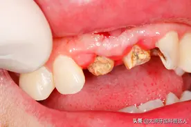 牙齿烂得只剩牙根，还有救吗？图片