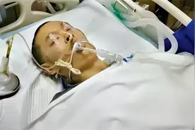 2011年男子下肢被烧焦，医生将十万只蛆虫放他身上啃咬，如今怎样图片