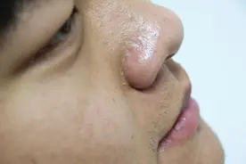 肝脏病变并不沉默，皮肤出现3种变化，别以为是皮肤问题图片
