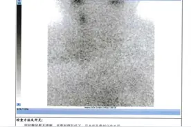 甲癌十年（七）131治疗（1）图片