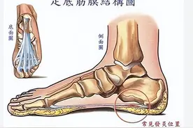 足底筋膜炎的康复治疗图片