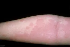 睡觉一受热，浑身上下痒，搞不好你有这3个皮肤问题图片