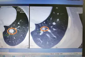 磨玻璃结节型肺癌生长速度最快有多快？一年体积可倍增不止10倍图片