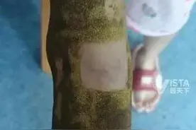 9岁女孩在杂草中被蛇咬伤 奶奶抓蜘蛛放伤口“吸出毒素” 就医被查出有蛇毒和蜘蛛毒图片