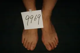 湖北洪湖大姐来做拇外翻手术，花几个小时跑过来，但我没给她手术图片