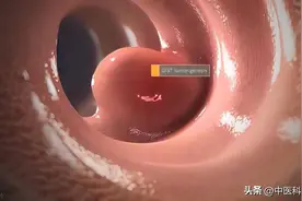 为什么肠道容易长“息肉”？肠子如果有息肉，身体会有哪些表现？图片