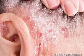 膝盖手掌双臂脸上长癣干燥脱皮痒擦什么药图片