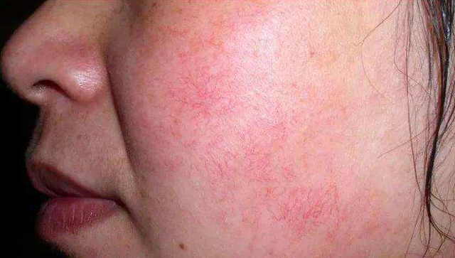 面部潮红,脱皮,肿胀,脸上痒得像子在脸上爬,这是过敏吗?