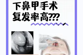 下鼻甲手术复发率高？其实是你没选对方法！图片