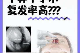 下鼻甲手术复发率高？其实是你没选对方法！图片
