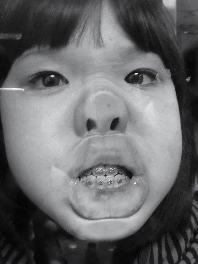 32岁女星承认整容!鼻子变歪一推就动需手术修复,曾经还全身抽脂