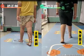 内翻足和外翻足区别以及治疗方法图片