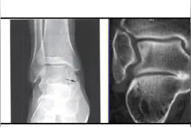 伤不起的踝关节痛——跟距骨桥图片