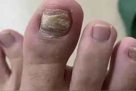 去除灰指甲只需要这2招！在家就能做！掌握方法终身受益！图片
