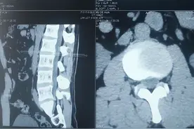 13年腰突治疗历程，椎间盘L5/S1突出伴有小腿持续抽筋康复图片