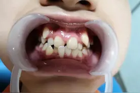 花费4000元，戴了2年的牙套，拯救了儿子一口歪七扭八的牙齿图片