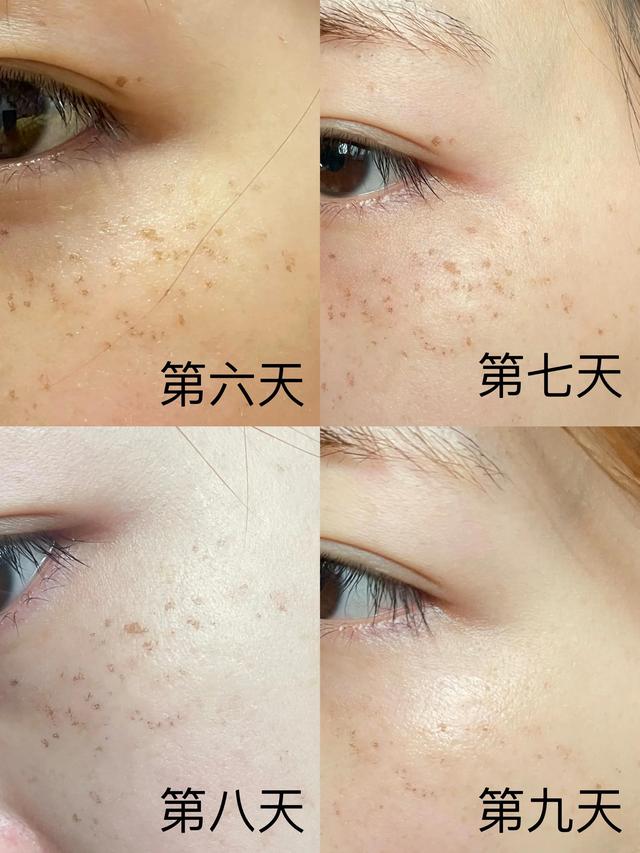 皮秒祛斑后恢复过程（实拍无美颜）