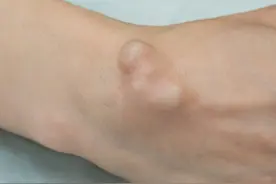 囊肿，结节，增生皆因痰和郁，送你五种中成药 化瘤，散结，消囊肿图片