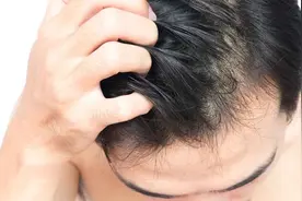 头皮瘙痒，难以忍受？多半与这4个原因有关，需对症处理图片