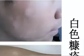 儿科医生说：儿童常见皮肤病之白色糠疹（颜面白斑）图片