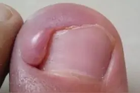 脚趾头红肿，一碰就痛，稍微走快一点都受不了，该怎么办？图片