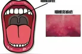 入园最讨厌的疱疹性咽峡炎来了图片