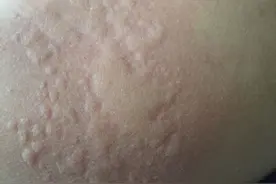 痒得不行！孩子得了荨麻疹，该怎么办？图片