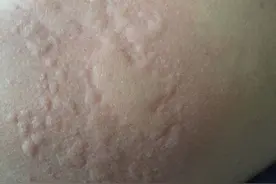 痒得不行！孩子得了荨麻疹，该怎么办？图片