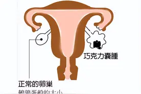 巧克力囊肿怎么解决？为爱美的你推荐巧克力囊肿单孔手术图片
