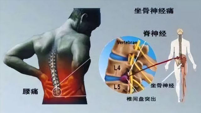 0.15元一片的甲钴胺是治疗腰椎间盘突出的神药吗？它有哪些作用？