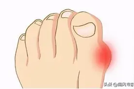 “阻挡”痛风再发作，做好这3件事，比一味吃药更重要图片