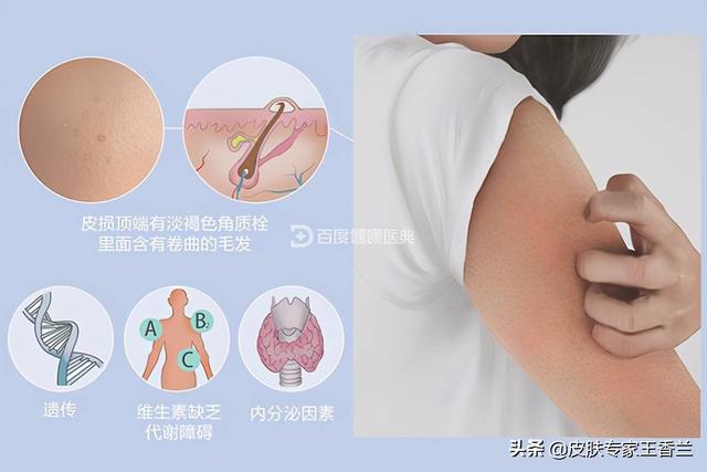 去医院皮肤病看鸡皮