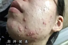 脸上长硬硬的小鼓包流脓血一碰就疼怎么办图片