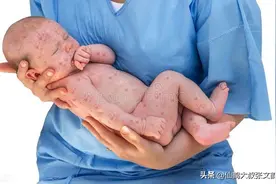 孩子冬季起红疹子的四个阶段图片