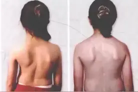 超500万孩子脊柱侧弯，严重可致瘫痪！娃的这些不良习惯赶紧改图片