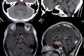 出现这样的头痛，可能与脑肿瘤有关，医生忠告：早发现不难治图片