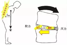 腿痛，以为是腰突，西医却说腰椎管狭窄！中医用一种药治两种病图片