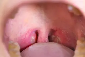 咽炎、咽喉不利、咽喉肿痛，这几款利咽清喉的成药记得收藏备用。图片